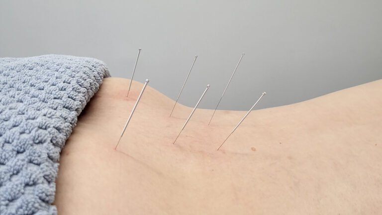 Dry Needling & Acupressure